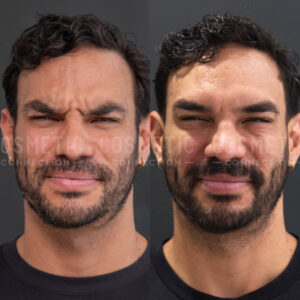Side-by-side comparison of a mans face before and after botox for wrinkles, showing smoother skin and fewer lines in the after photo on the right.