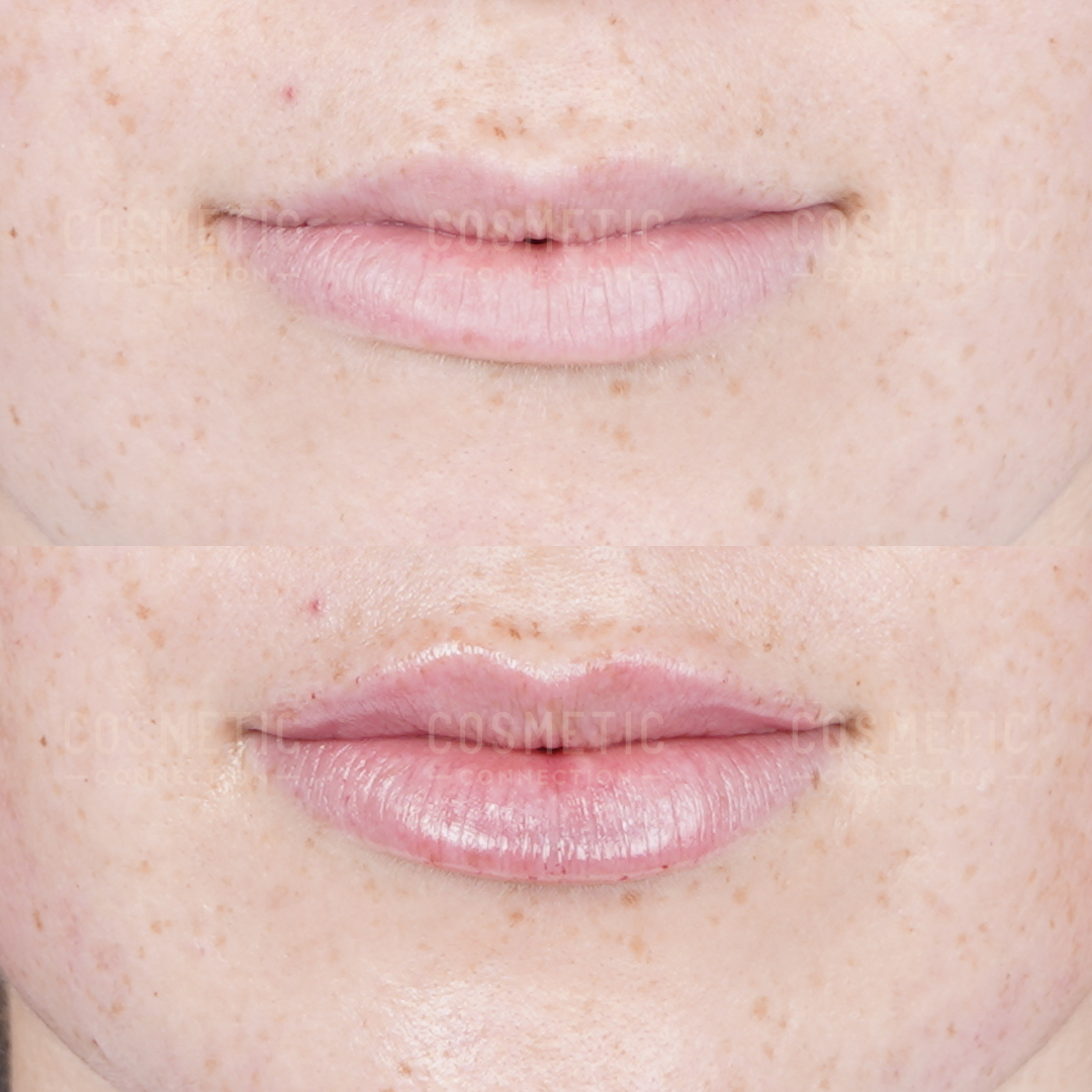 Two close-up images of a persons lips and lower face, showing a before (top) and after (bottom) comparison with fuller lips and slightly enhanced shape in the after image. Freckles are visible on the skin.