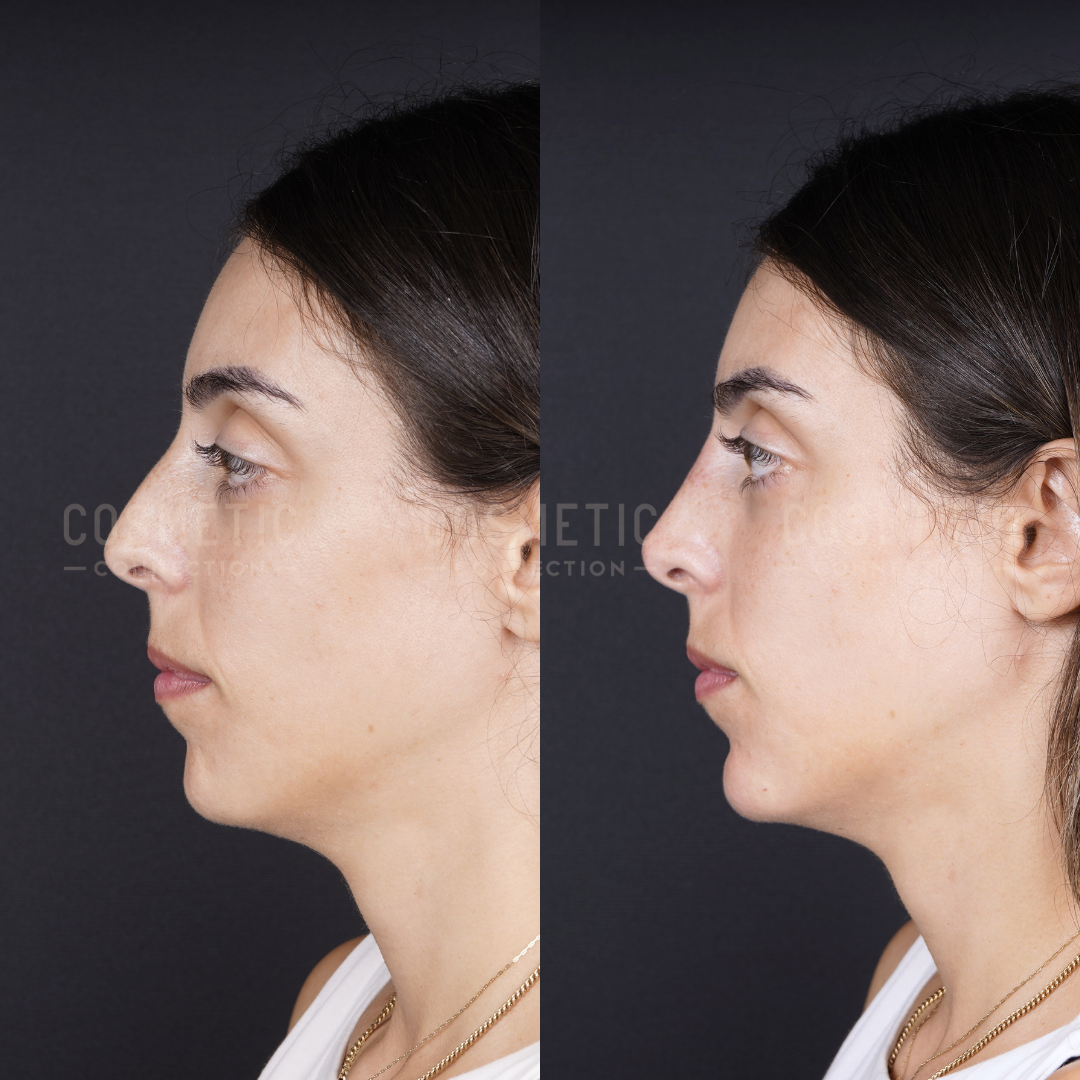 Side-by-side profile photos of a woman before (left) and after (right) a cosmetic procedure showing changes to her nose and chin against a plain dark background.