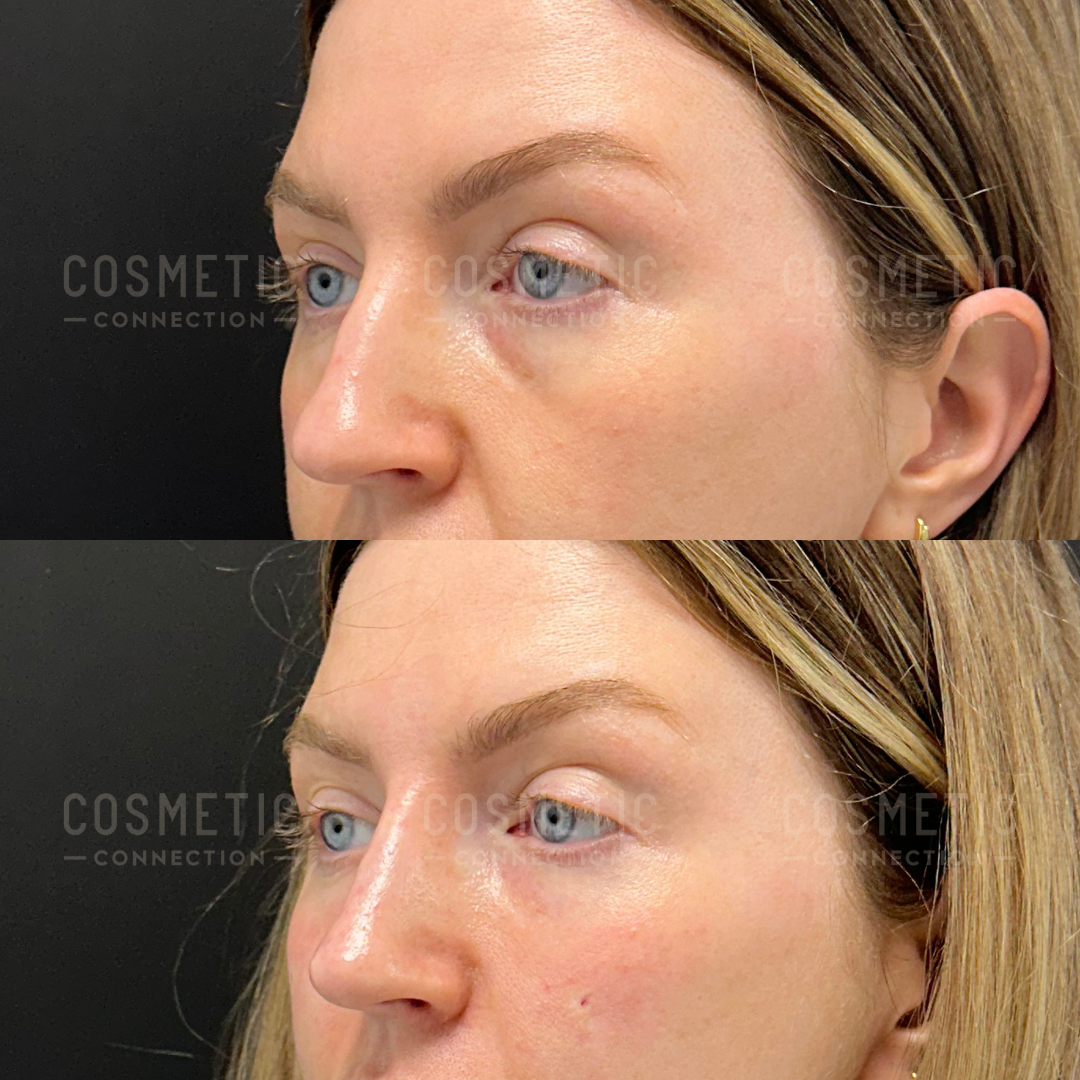 Side-by-side photos of a womans face before (top) and after (bottom) a cosmetic procedure showing reduced under-eye hollowness and smoother skin beneath the eyes. The lighting and angle are similar in both images.