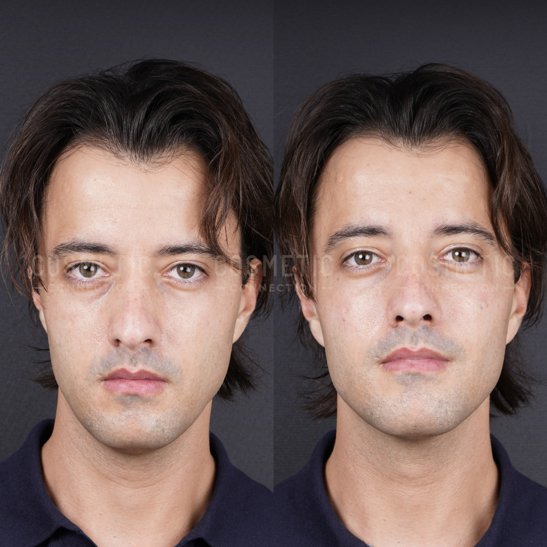 Side-by-side photos of a man with medium-length brown hair, before and after a treatment. In the after image, his skin appears smoother and his facial expression is slightly more relaxed.