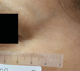 A close-up of a persons skin with a ruler placed horizontally for scale. The area shows a mild indentation or dimple. Part of the image is blacked out for privacy.