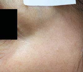 Close-up of a persons cheek with smooth, light brown skin. There is a white patch at the top edge and a black rectangle obscuring part of the upper left area.