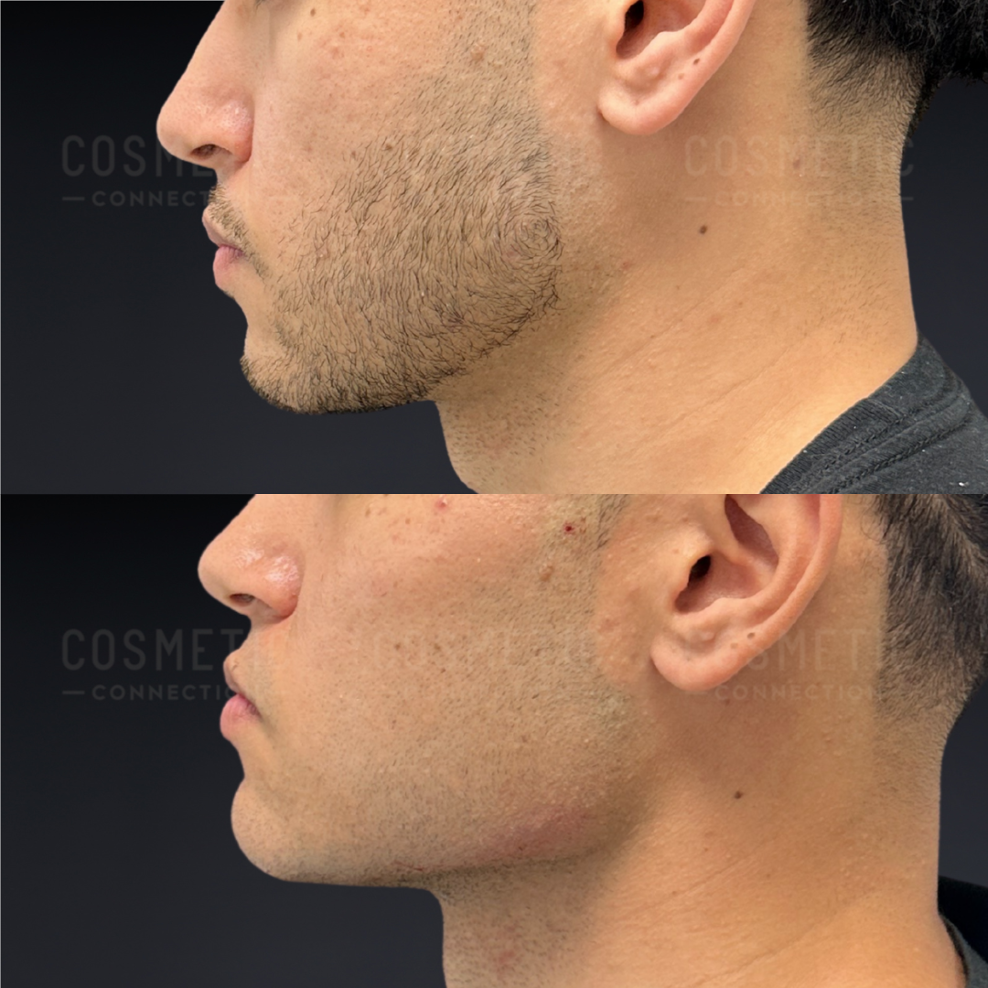 Side-by-side comparison of a mans jawline, showing thicker facial hair and stubble in the top image, and a clean-shaven, smoother jawline in the bottom image.