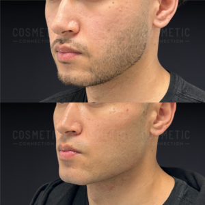 Side-by-side comparison of a mans face before and after chin dermal fillers and jawline dermal fillers. The top image shows a weak jawline and recessed chin. The bottom image shows a stronger chin and defined jawline.