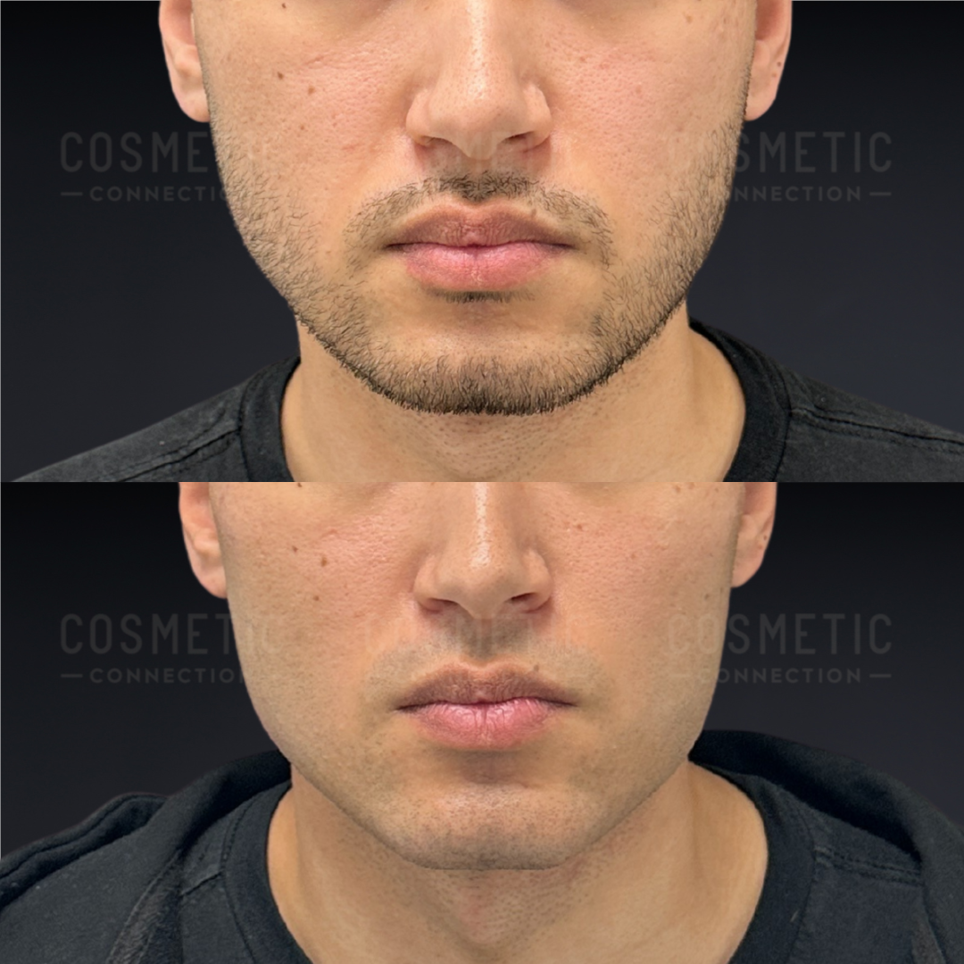 Side-by-side close-up of a mans lower face showing a before and after cosmetic treatment; the after image shows a cleaner jawline and smoother skin with less visible stubble.