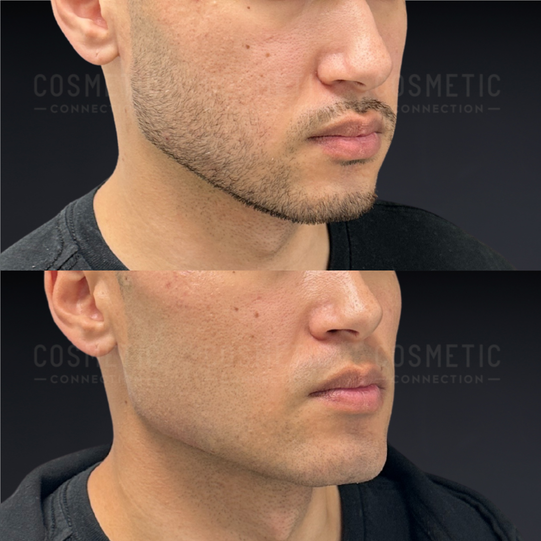 Side-by-side comparison of a man’s lower face before and after a jawline enhancement procedure, showing increased jawline definition and a more contoured appearance in the after image.