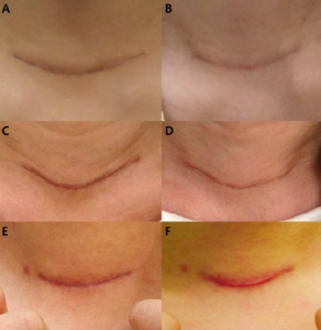 Six close-up images (labeled A–F) show healing scars on the front of a persons neck. Each scar varies in redness, texture, and stage of healing. The backgrounds and lighting differ slightly in each image.