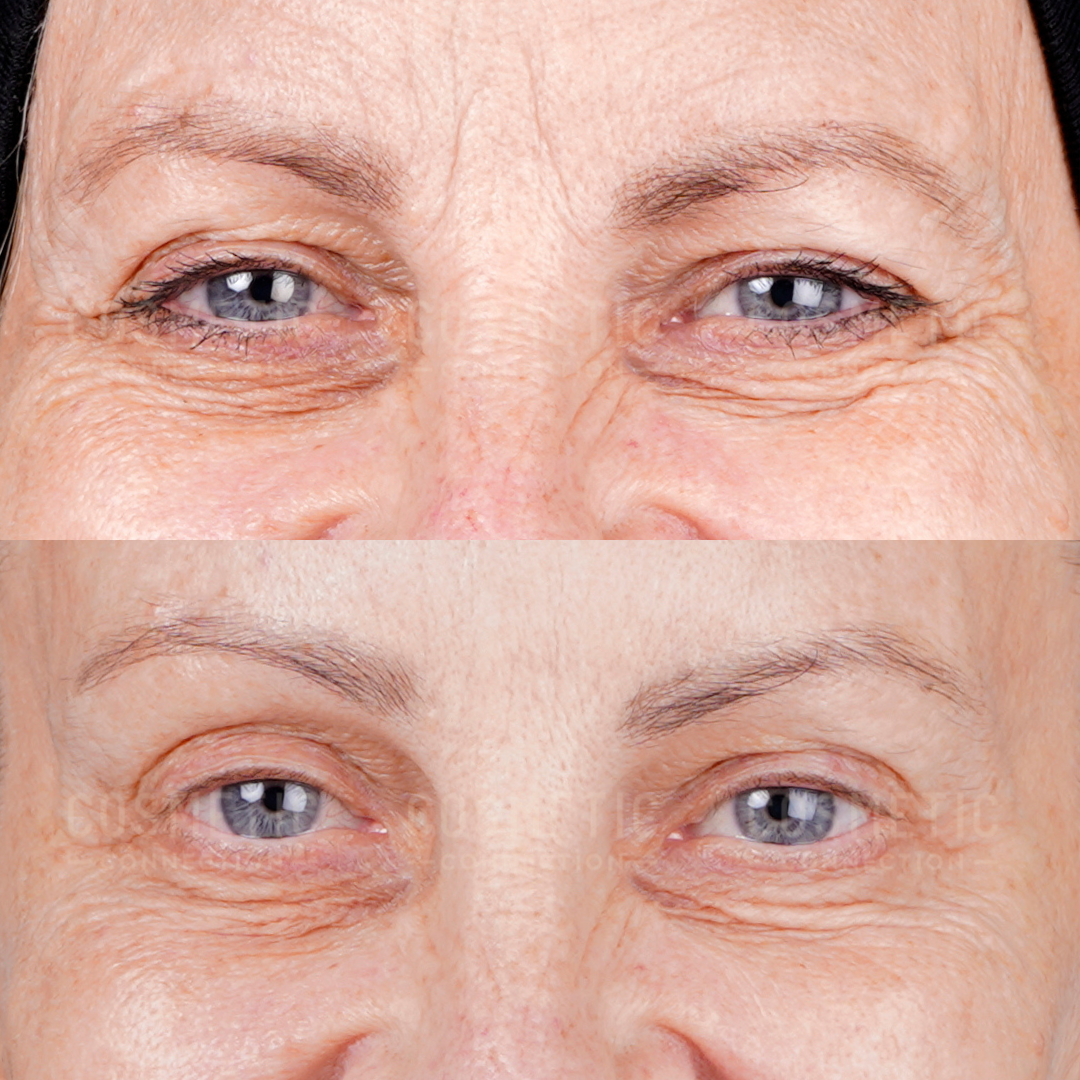 Close-up comparison of a persons eyes and upper cheeks, showing before (top) and after (bottom) results. The after image has smoother skin with reduced wrinkles and fine lines around the eyes.