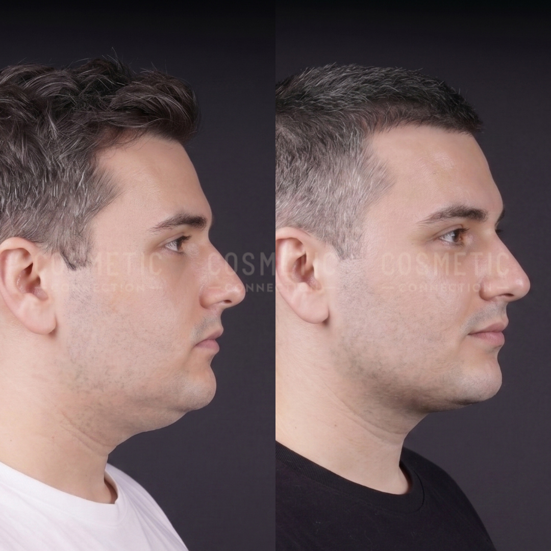 Side-by-side profile photos of a man before and after a cosmetic procedure, showing a more defined chin and jawline in the after image compared to the before image.