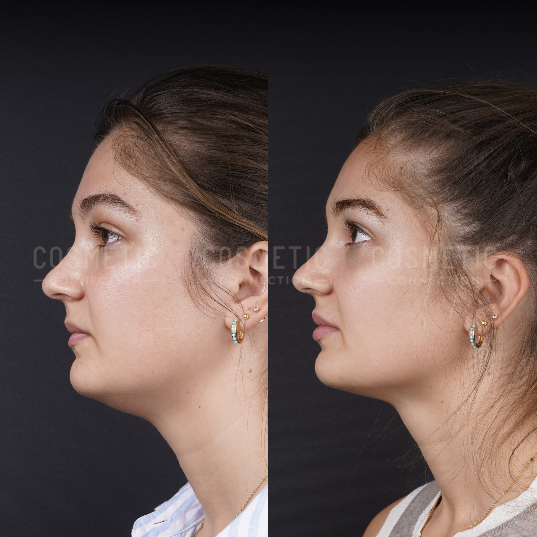 Side-by-side profile photos of a young woman before and after a cosmetic procedure, showing a more defined jawline and chin in the after image. She wears multiple earrings and a white top in both photos.