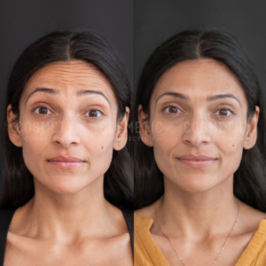 Side-by-side comparison of a womans face before and after botox for wrinkles, showing smoother skin and fewer lines in the after photo on the right.