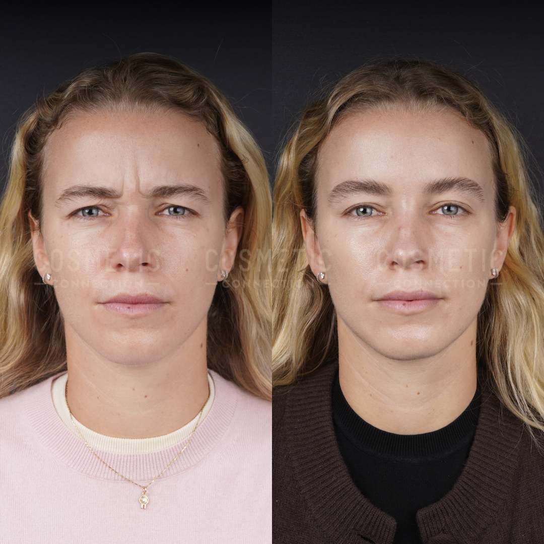 Side-by-side comparison of a woman’s face before (left) and after (right) a cosmetic procedure, showing reduced forehead wrinkles and smoother skin. She has long blonde hair and a neutral expression in both images.