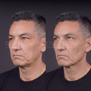 Side-by-side photos of a man before and after a dermal fillers to the chin and jawline, showing a more defined facial contours, reduced facial shadows, and slightly lifted facial features in the after image.
