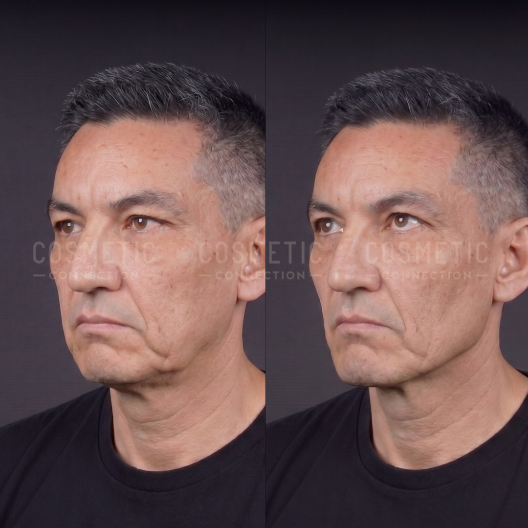 Side-by-side comparison of a middle-aged man before (left) and after (right) a cosmetic procedure, showing smoother skin and reduced sagging along his jawline and cheek. He is wearing a black shirt and looking slightly upward.