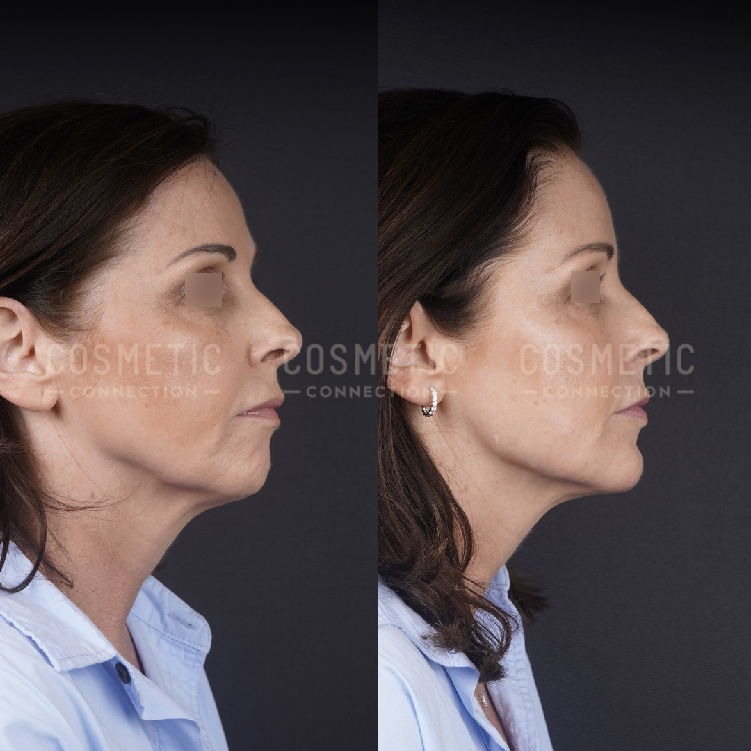 Side-by-side profile photos of a woman before and after a cosmetic procedure, showing a noticeable reduction in sagging skin and a more defined jawline and neck in the after image.