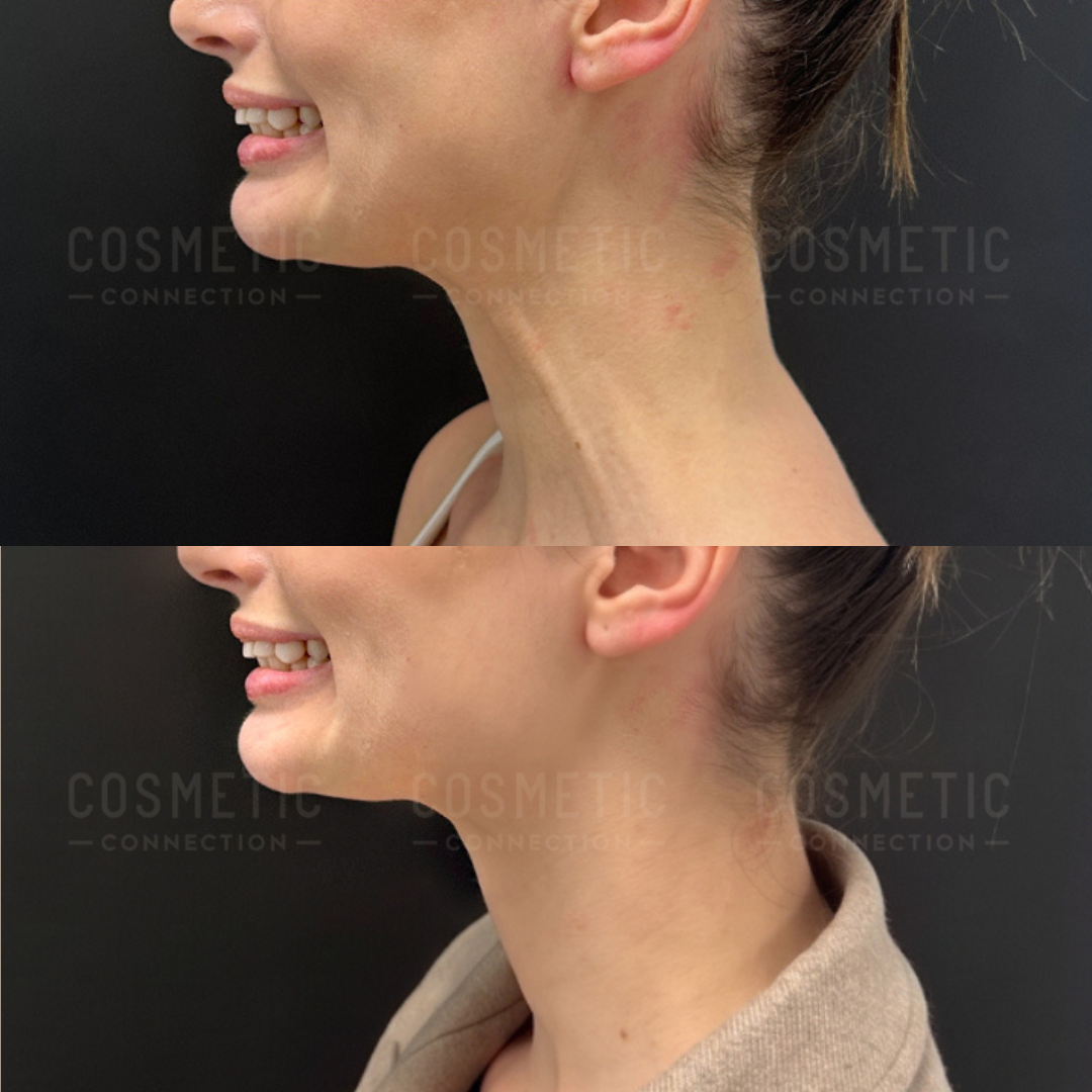 Side-by-side before and after photos of a woman’s profile, showing a noticeable improvement in jawline and neck contour after a cosmetic procedure.