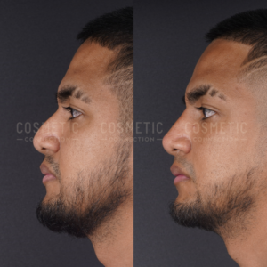 Side-by-side profile photos of a man before and after a non surgical rhinoplasty. The left image shows a more prominent nose bridge, while the right image shows a straighter nose and refined appearance.