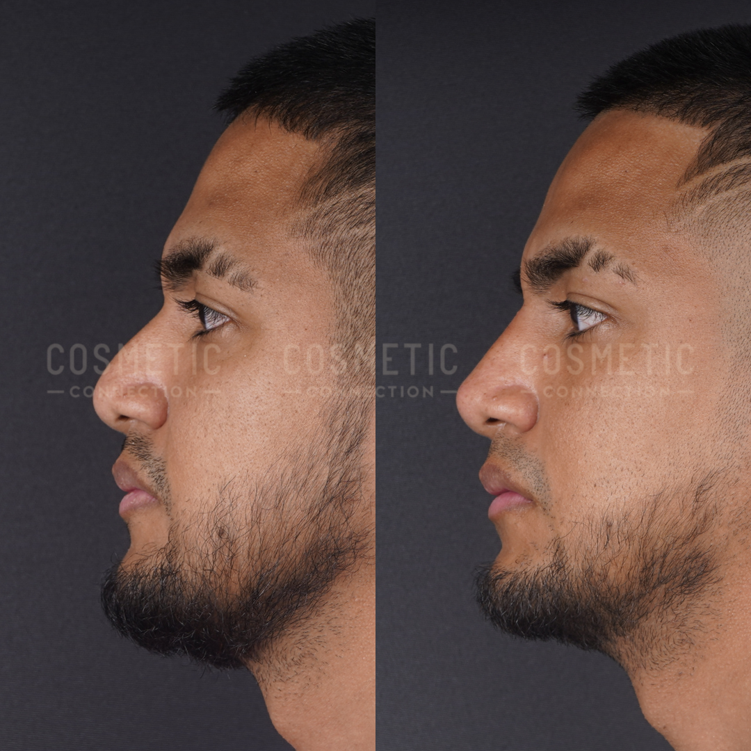 Side-by-side profile photos of a man before and after a cosmetic procedure. The left image shows a more prominent nose bridge, while the right image shows a straighter nose and refined appearance.