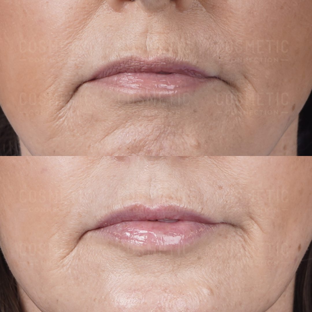 Close-up before and after photos of a womans lower face, showing reduced wrinkles and fuller lips in the after image, likely following a cosmetic treatment or procedure.