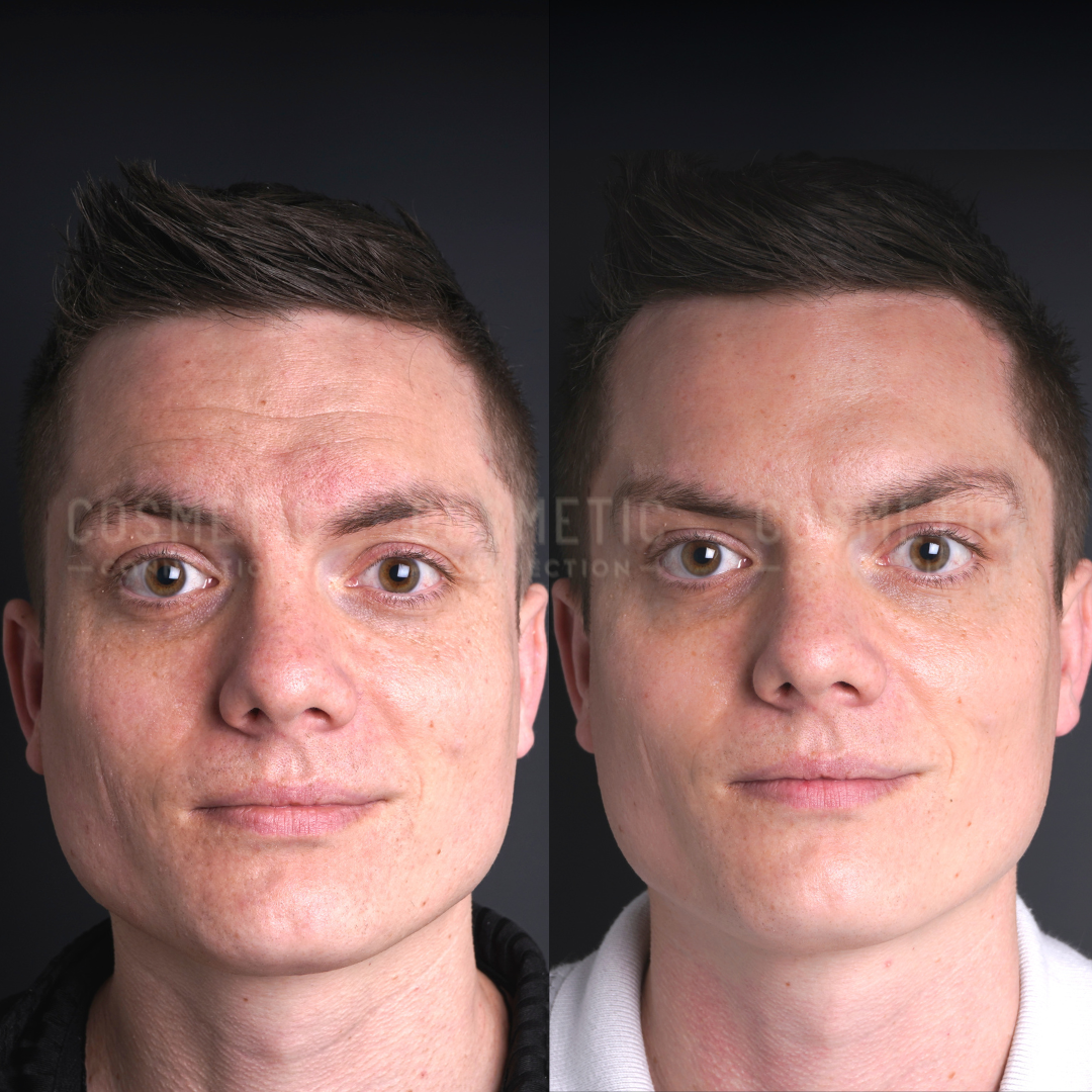 Side-by-side comparison of a mans face before and after a cosmetic procedure, showing smoother skin and fewer blemishes in the after photo on the right.