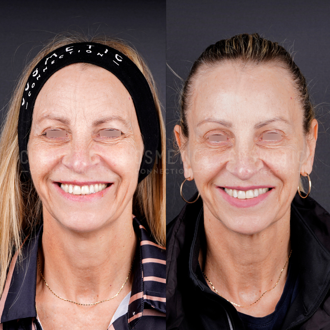 Side-by-side photos of a smiling woman before (left) and after (right) a cosmetic procedure. Her eyes are blurred for privacy. She wears a headband in the first image and has her hair tied back in the second.