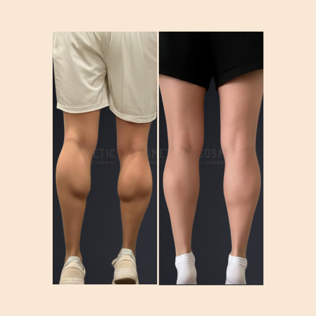 Side-by-side comparison of two pairs of legs from behind, showing a visible reduction in calf size in the right image compared to the left. Both individuals are wearing shorts and sneakers.