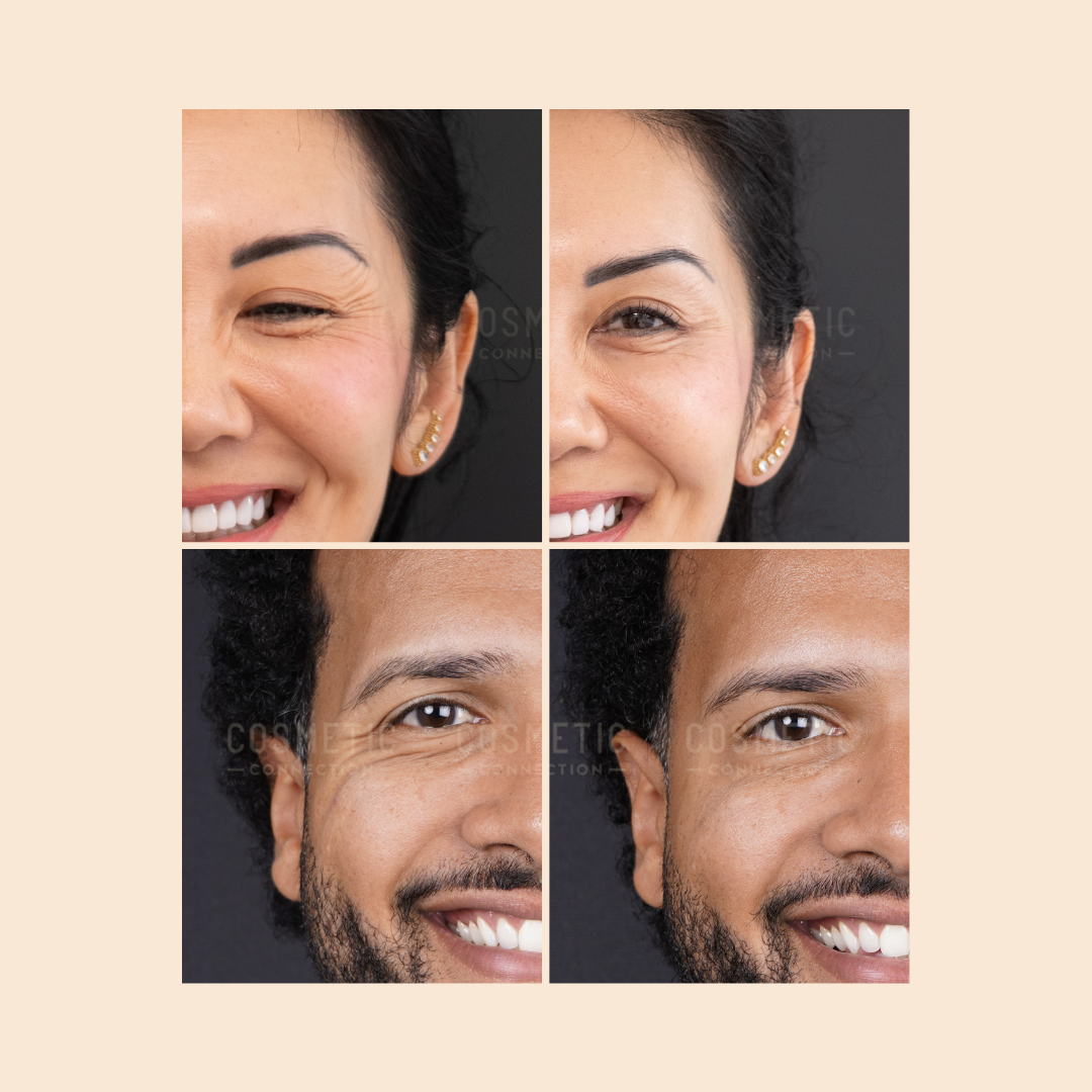 A collage of close-up before-and-after photos showing two people’s faces, one female and one male, highlighting reduced wrinkles around their eyes and smoother skin in the after images.