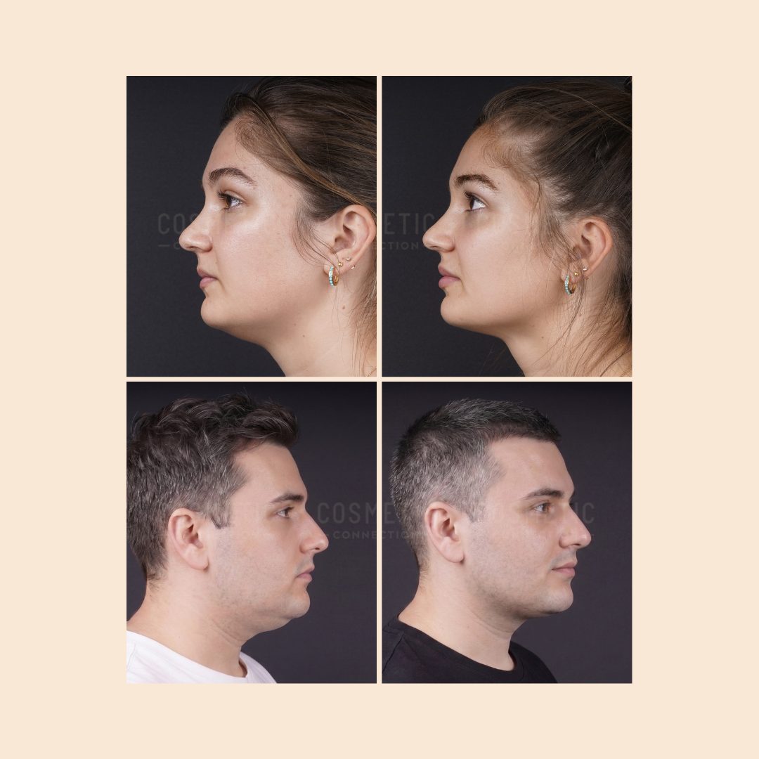 Side-by-side before and after profile photos of a woman and a man, showing visible changes in their jawlines and necks, suggesting cosmetic or medical treatment.