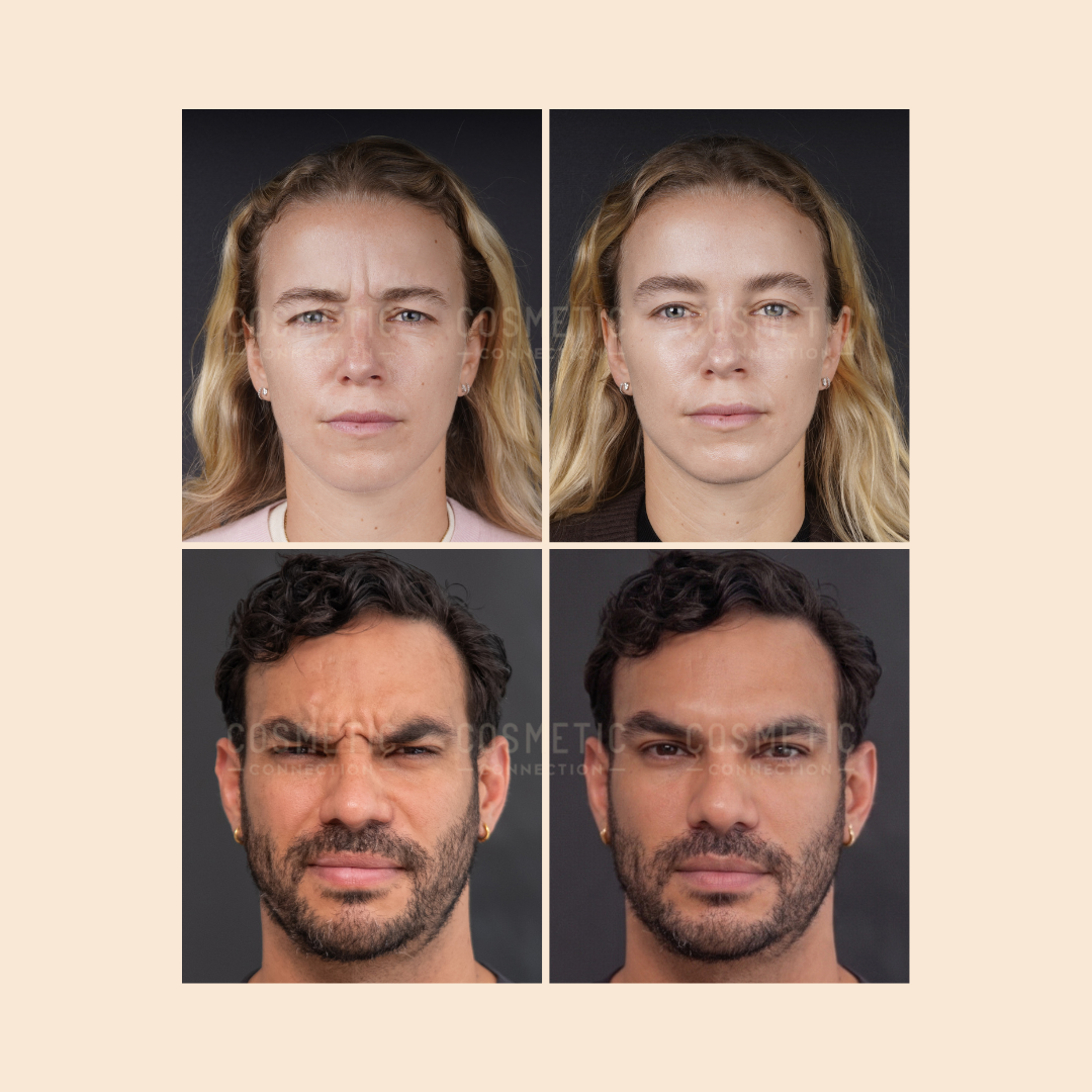 Side-by-side before-and-after photos of two people, one woman and one man, with neutral expressions in the after images and furrowed brows in the before images, suggesting cosmetic treatment results.