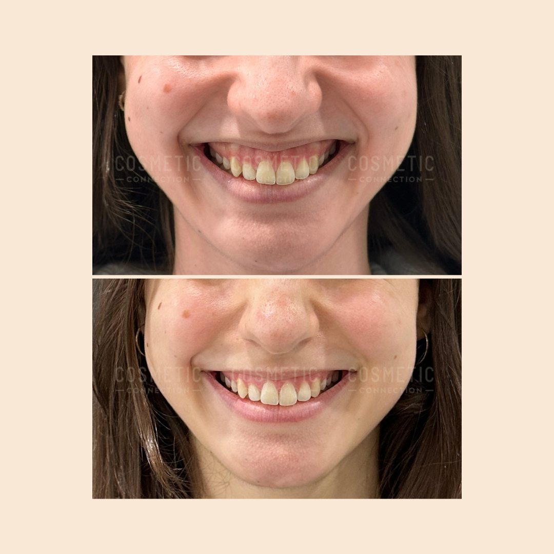 Two close-up images show a person smiling. The top image displays uneven gums and teeth, while the bottom image shows an improved, even gumline and teeth after a dental procedure.