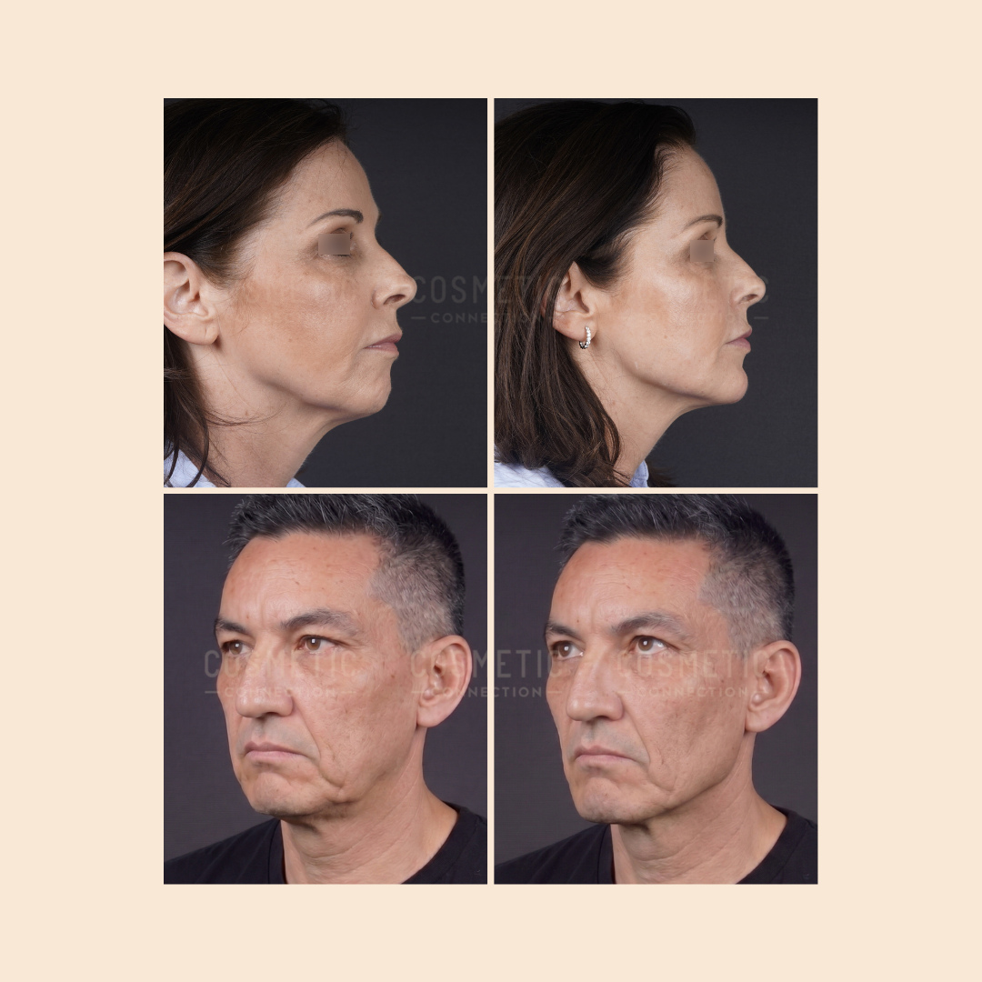 Four photos show before and after side-by-side comparisons of a woman and a man, highlighting changes in their jawlines and neck areas, likely as a result of cosmetic procedures.