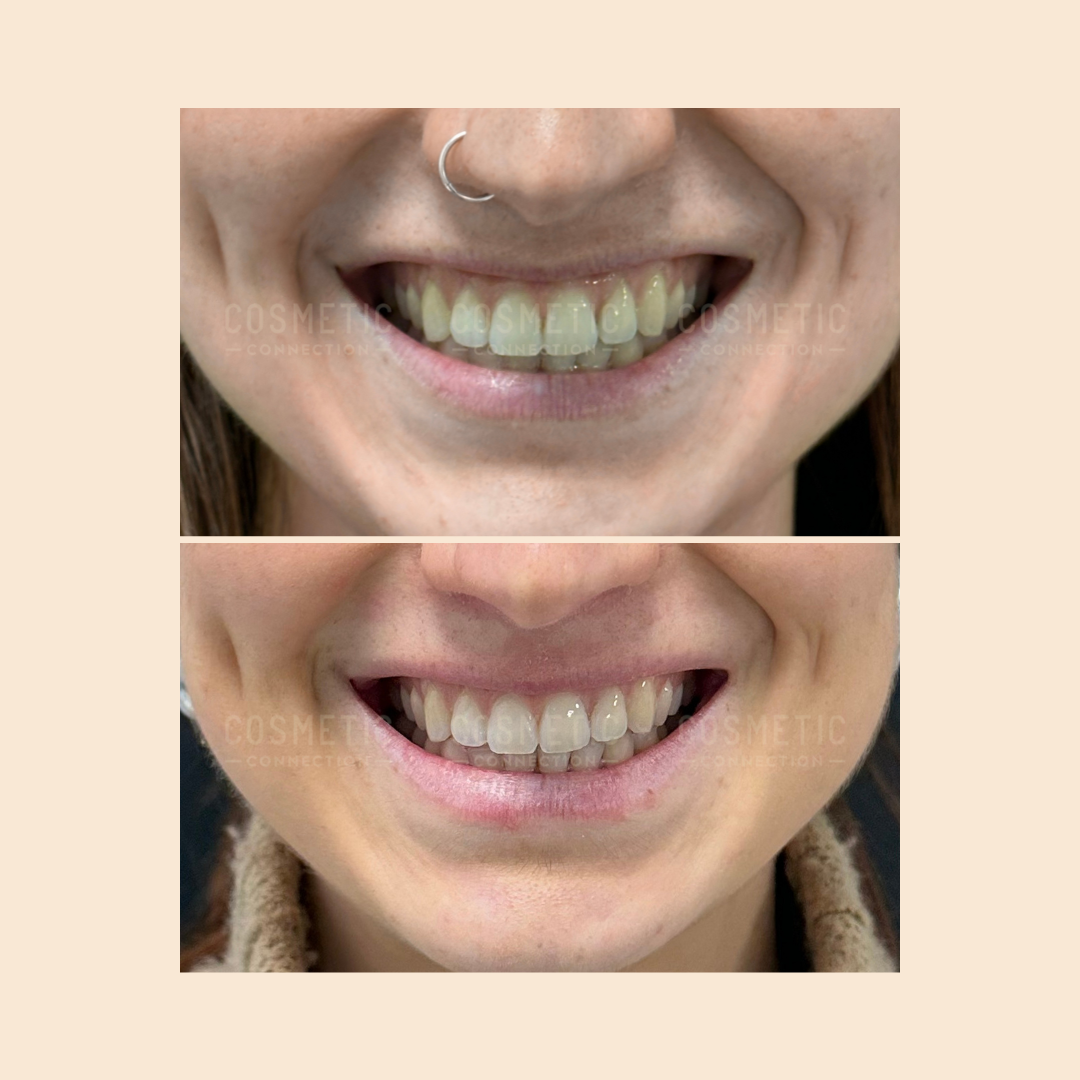 Close-up before-and-after photos of a womans smile showing teeth whitening results; in the top image, her teeth are yellowish, while in the bottom image, they appear whiter and brighter.