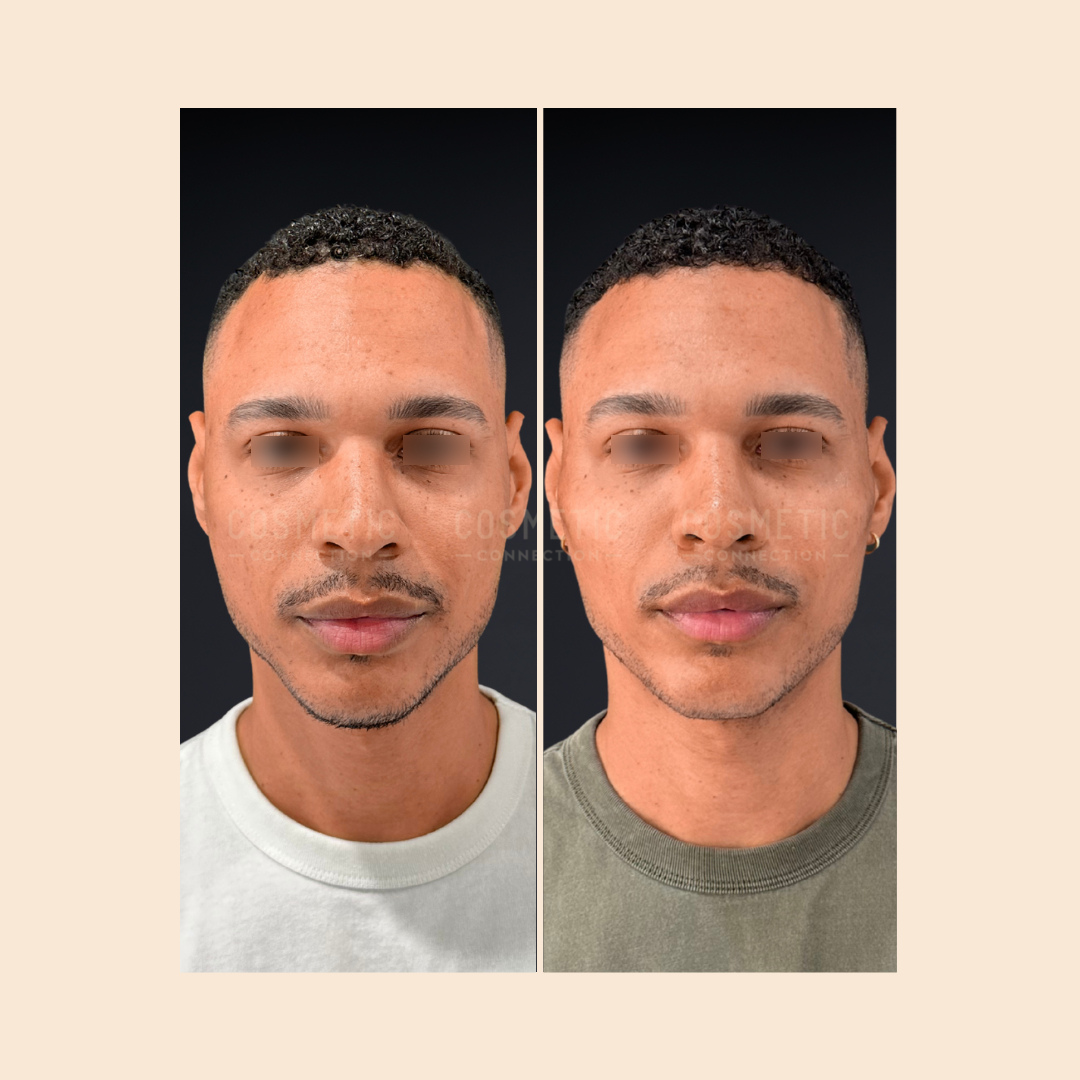 Side-by-side comparison of a man before and after a cosmetic procedure, with both images showing his face from the front against a dark background. He wears a light shirt in the left image and an olive shirt in the right image.