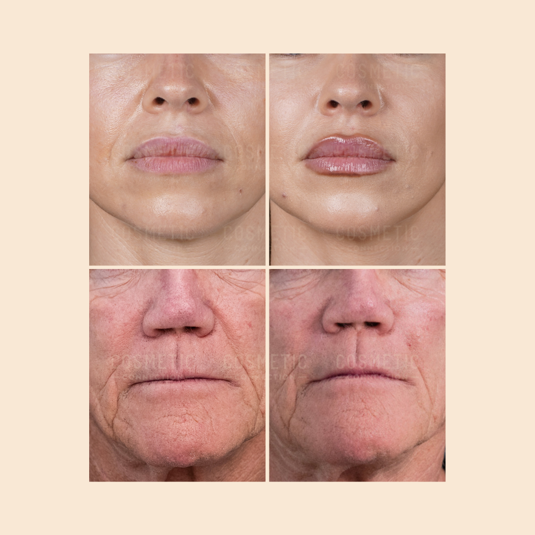 Before-and-after close-up photos of two people’s lower faces showing visible improvements in lip volume and wrinkle reduction after a cosmetic treatment. Top row: younger person; bottom row: older person.