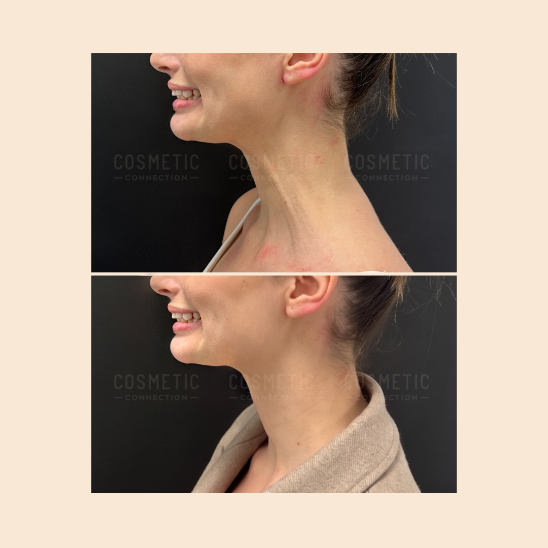 Side-by-side before and after photos of a woman’s neck, showing a prominent neck muscle in the top image and a smoother neck contour in the bottom image. Both photos are taken from a side profile.