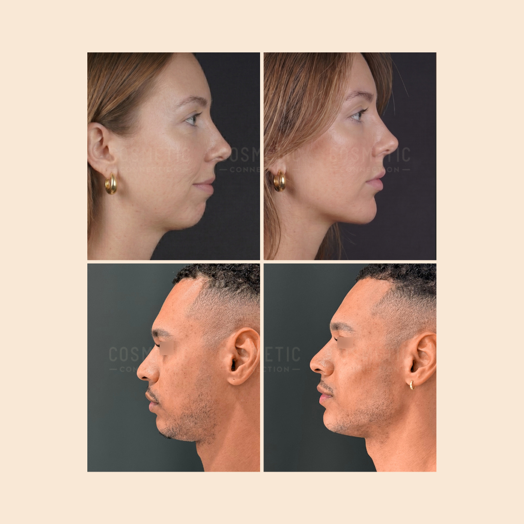 Two sets of before-and-after profile photos show a woman (top) and a man (bottom) with visible changes to their jawlines and chins, indicating possible cosmetic procedures. Both have neutral expressions and are facing left.