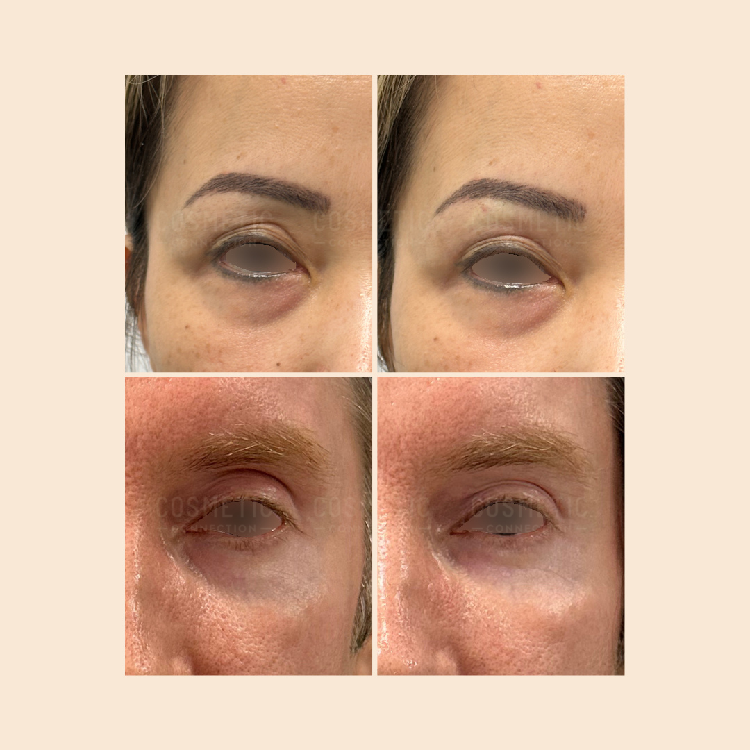 A collage of four close-up images showing two people’s eyes before and after cosmetic procedures, highlighting changes in skin texture, under-eye area, and eyebrows.