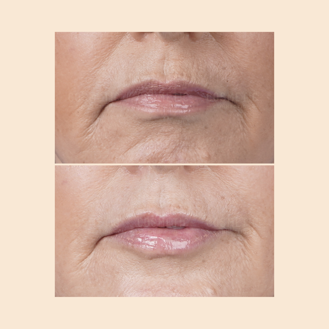 Close-up of a persons mouth area, showing a before (top) and after (bottom) comparison. The lower image shows smoother skin and fuller lips, indicating cosmetic improvement or treatment.