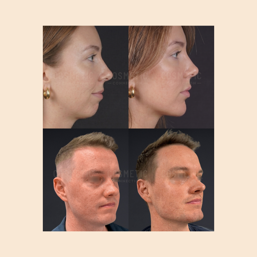 A before-and-after comparison of two people, a woman and a man, showcasing side profile improvements in their jawlines and chins following cosmetic procedures.