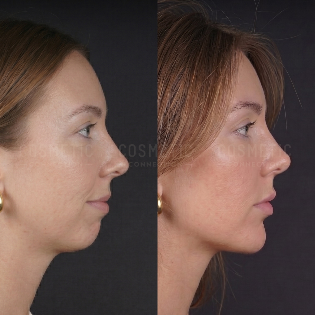 Side-by-side profile photos of a woman before and after a cosmetic procedure, showing changes to her nose, chin, and jawline. Her skin tone, hair color, and earrings remain the same in both images.