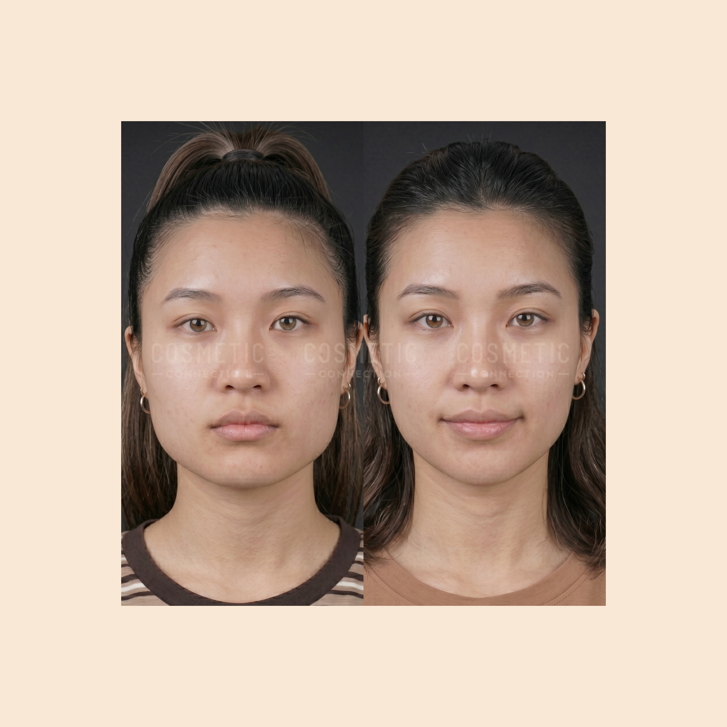 Side-by-side photos of a woman facing forward, showing a before-and-after comparison. Her skin appears smoother and facial features look subtly enhanced in the after photo on the right.