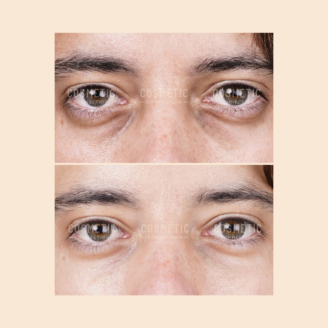 Close-up before-and-after images showing a persons eyes and upper nose; the top photo displays noticeable under-eye bags and dark circles, while the bottom photo shows smoother, less puffy under-eye skin.