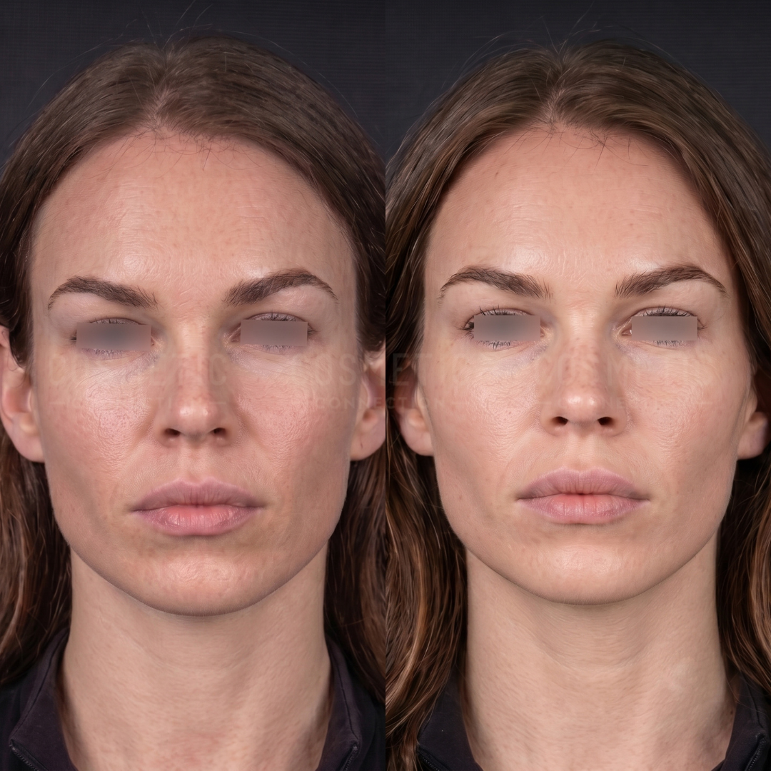 Side-by-side comparison of a womans face before and after a cosmetic procedure, showing smoother skin texture, fuller lips, and a more even complexion in the after image. Eyes are blurred for privacy.