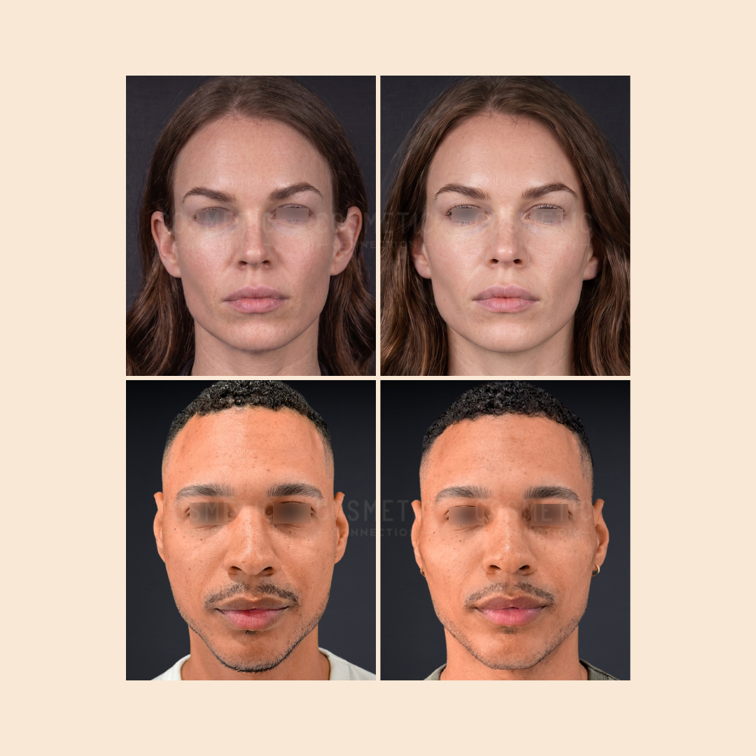 A grid of four photos shows two people, one woman (top row) and one man (bottom row), each pictured before (left) and after (right) cosmetic treatment. Their faces appear similar in both images.