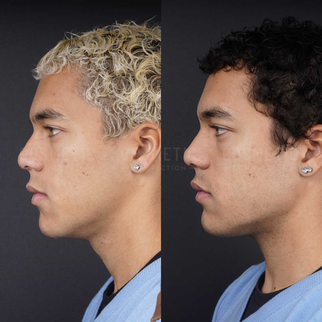 Side-by-side profiles of the same person, left with short, bleached curly hair and right with short, dark curly hair, both wearing a blue top and silver stud earrings, against a dark background.